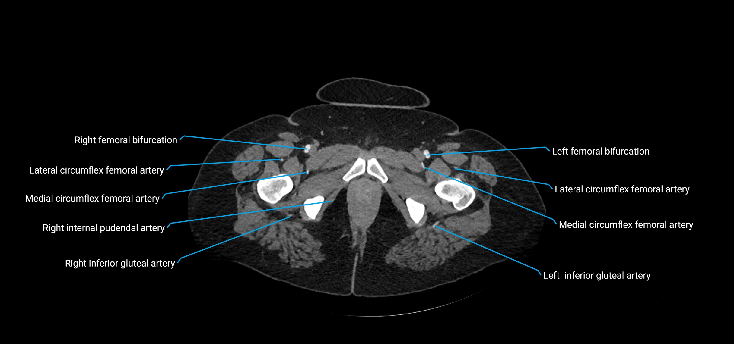CTA abdomen axial cross sectional anatomy labelled image_271 (2).webp